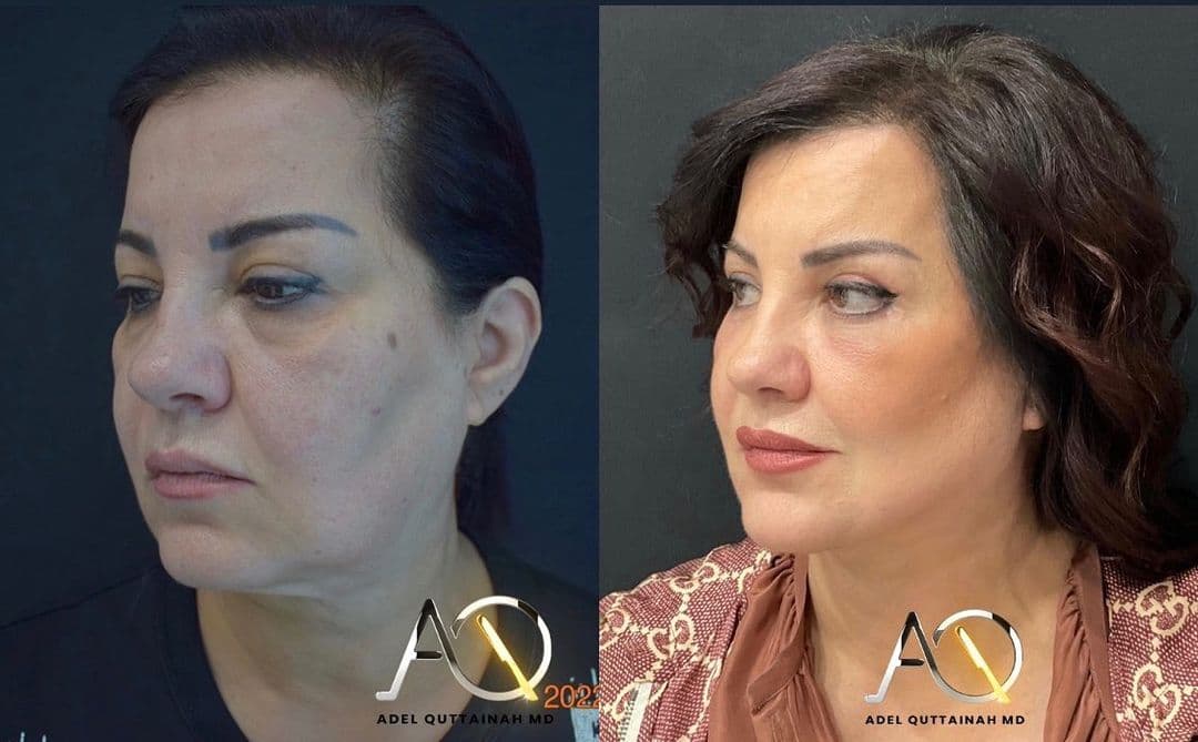 Face & Neck Lift Before and After